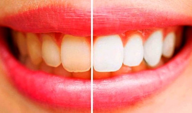 Diş Beyazlatma ile Parlak Bir Gülümseme İçin Pratik Bilgiler;